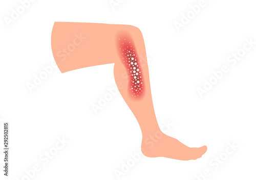 skin disease vector / psoriasis on hand
