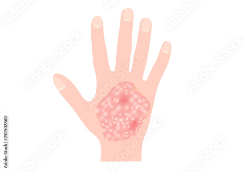 skin disease vector / psoriasis on hand