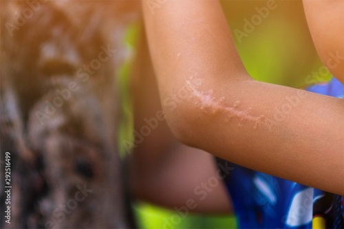 The scar on the arm of a child