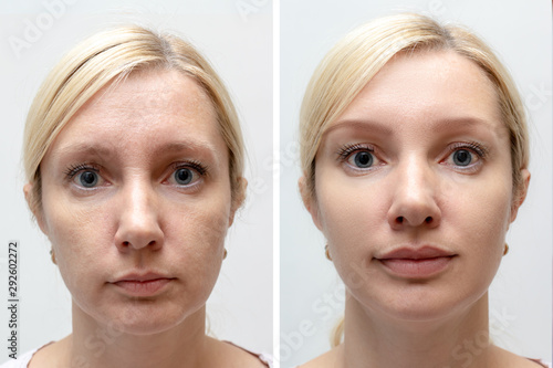 Obraz na plátně Woman face with wrinkles and age change before and after treatment - the result