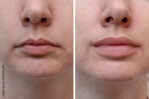Female lips before and after augmentation, the result of using hyaluronic filler photo