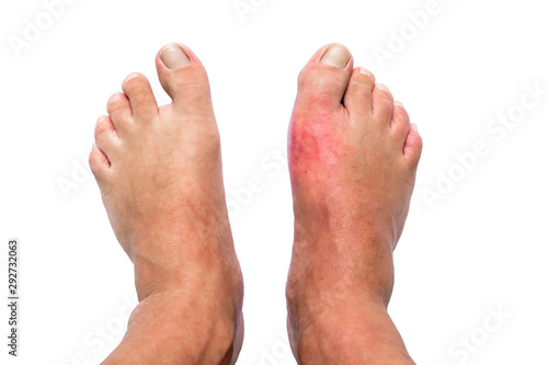 Man with right foot swollen and painful gout inflammation isolated on white background photo