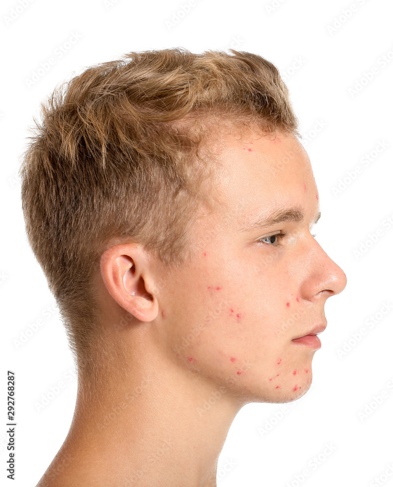 Fototapeta premium Teenage boy with acne problem on white background