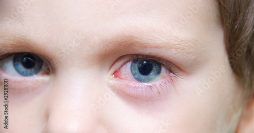 conjunctivitis in the eye of a child. Ophthalmic diseases. Red eye . Vessels burst in the eye. photo