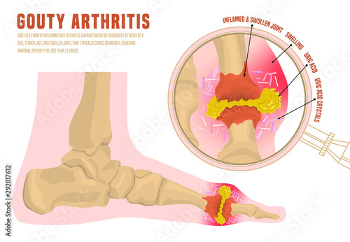 Gout arthritis infographic