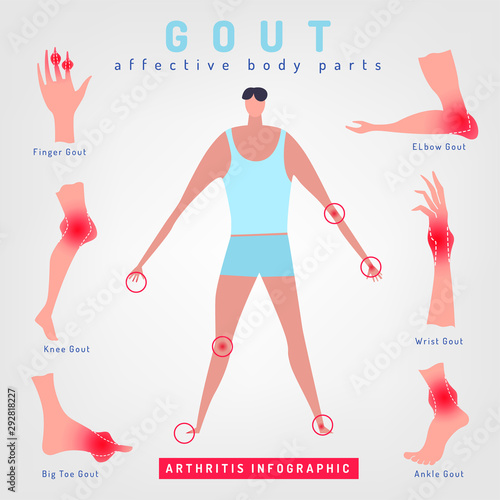Gout arthritis infographic