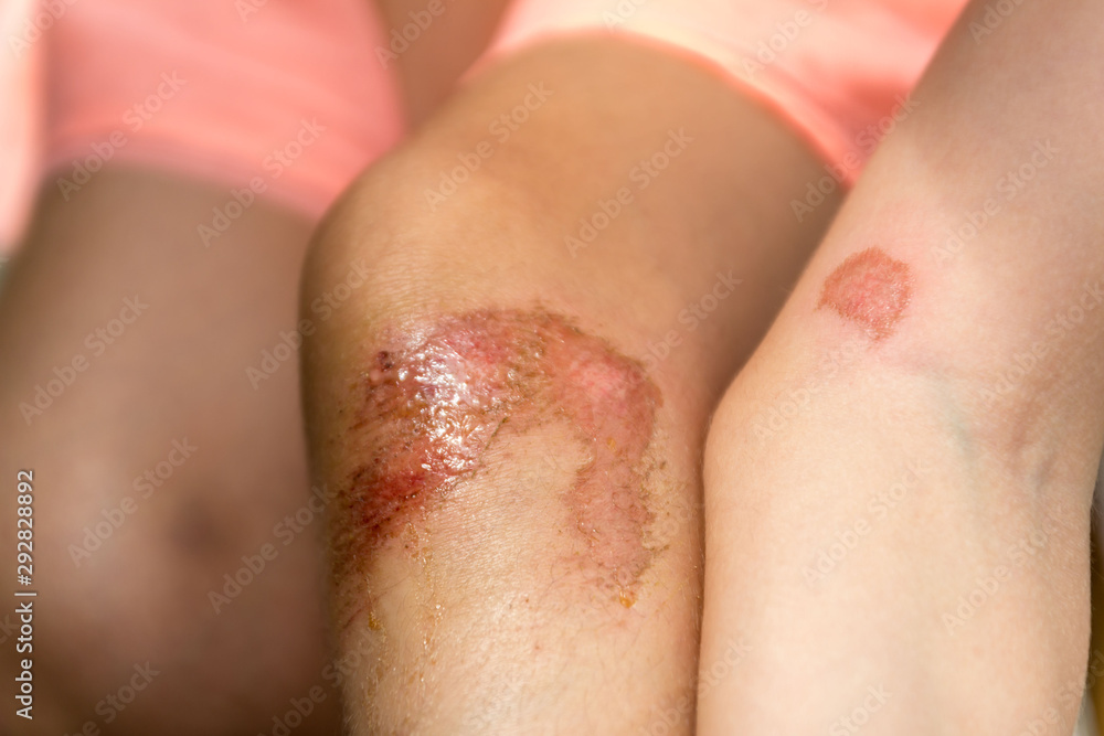 Naklejka premium Wounds on the knee and the elbow of a small child. Bicycle accident. Selective focus.