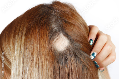 30 year old Caucasian woman with spot alopecia, bald spot on her head