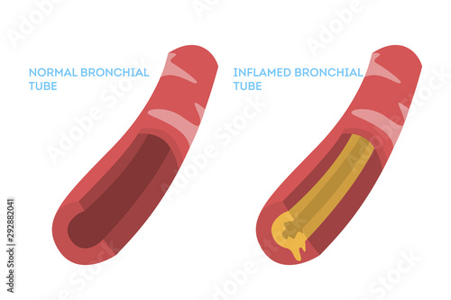 Normal and inflamed bronchial tube. Symptom of bronchitis