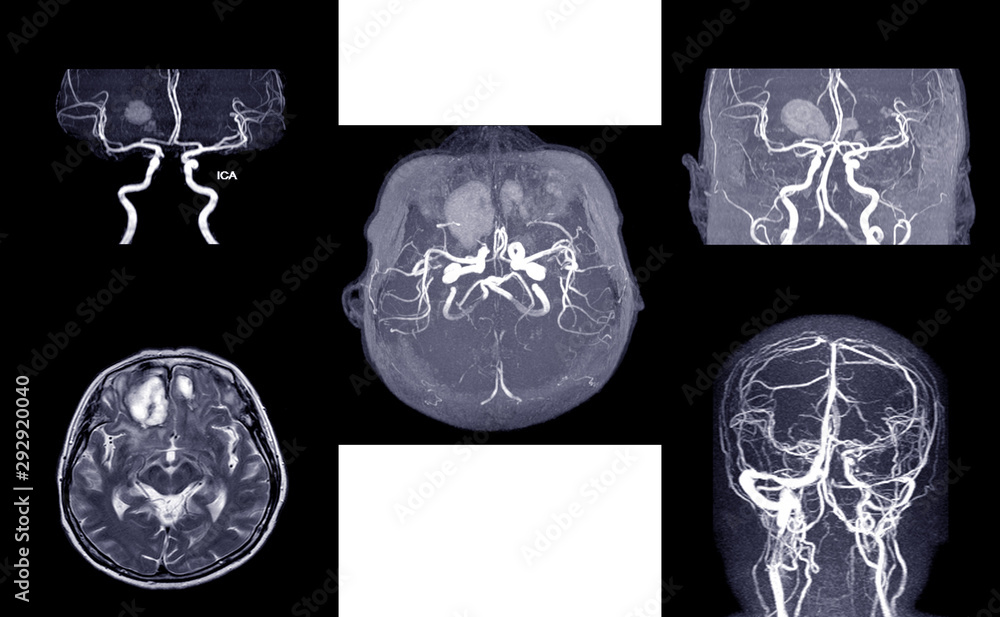 MRA AND MRV OF BRAIN:, presented with intracranial hemorrhage.This study was sent to evaluate intracranial vascular abnormality at bilateral frontal lobes.Medical concept. MRA AND MRV OF BRAIN:, presented with intracranial hemorrhage.This study was sent to evaluate intracranial vascular abnormality at bilateral frontal lobes.Medical concept.