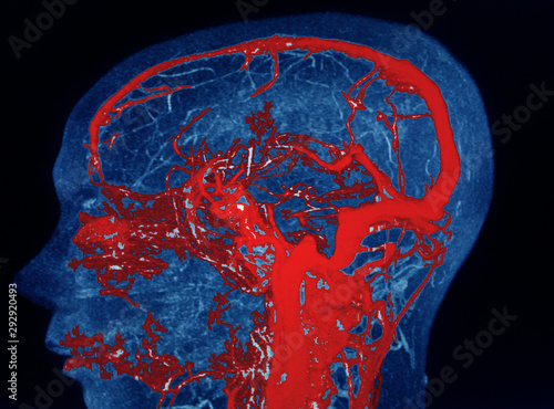 Obraz na plátně MRA AND MRV OF BRAIN Finding:Bilateral territorial muscles to the cortex and subcortical of the parietal and low hemispheres cerebellar