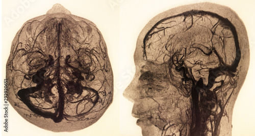 Quadro su tela MRA AND MRV OF BRAIN Finding:Bilateral territorial muscles to the cortex and subcortical of the parietal and low hemispheres cerebellar
