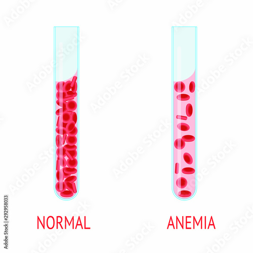 Red blood cells in anemia and Norman state vector image. Test tubes with blood cells in anemia and normal isolated vector color image on a white background.
