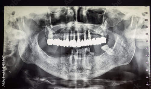 Orthopantomography of an adult patient, dentistry