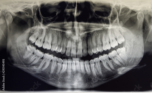 Orthopantomography of an adult patient, dentistry photo