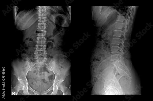 Two X-ray images of lumbar spine .Lumbar Degenerative Spinal Canal Stenosis or Herniated Nucleus Pulposus. 