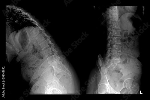 Two X-ray images of lumbar spine (Flex and left). Lumbar Degenerative Spinal Canal Stenosis or Herniated Nucleus Pulposus.