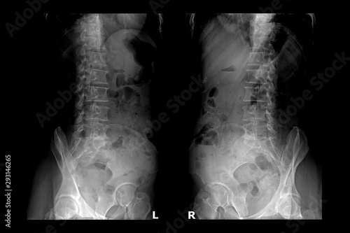 Two X-ray images of lumbar spine (left side and right side).Lumbar Degenerative Spinal Canal Stenosis or Herniated Nucleus Pulposus.