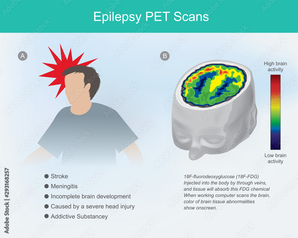 Epilepsy PET scans. The brain cells if concussion or Epilepsy disease