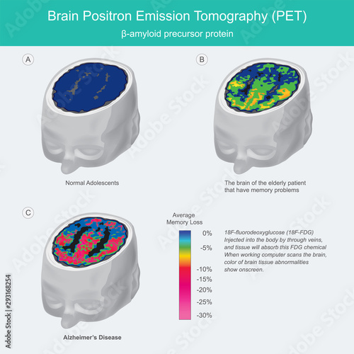 Brain PET scans. When working computer scans the brain, colour of brain tissue abnormalities show onscreen.