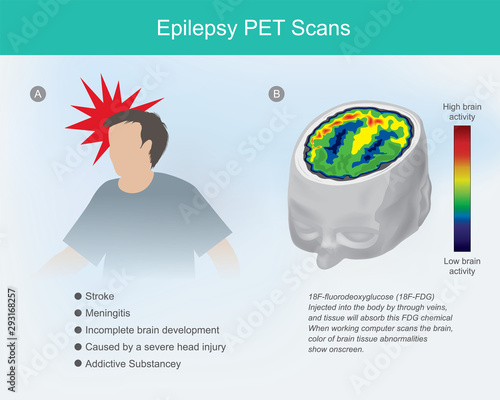 Epilepsy PET scans. The brain cells if concussion or Epilepsy disease, cause the brain to malfunction, Abnormalities can be imaging detected by using FDG PET scans.