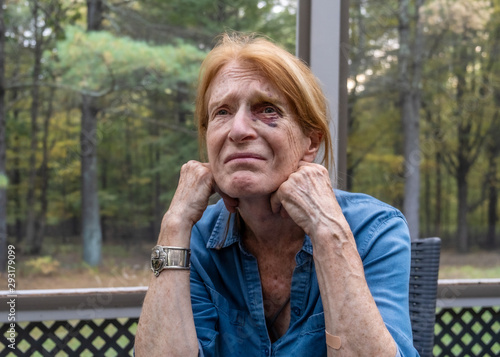 woman with black eye_3