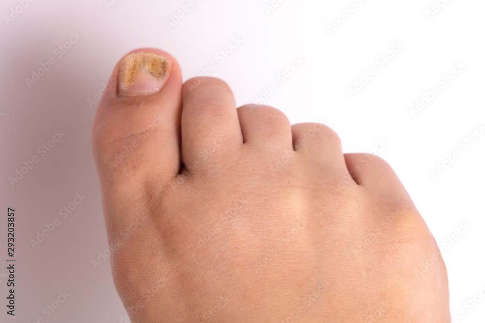 A closeup and top view on the bare foot of a caucasian person suffering from tinea unguium, a fungal infection causing yellow discoloration of the big toenail. A closeup and top view on the bare foot of a caucasian person suffering from tinea unguium, a fungal infection causing yellow discoloration of the big toenail.