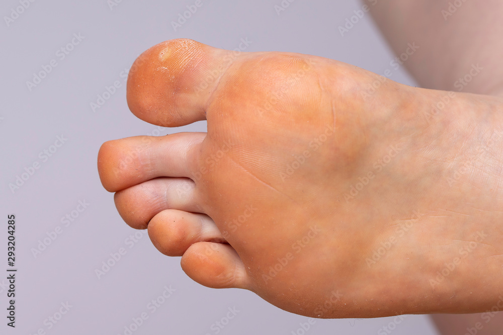 A close-up view on the underside of a human foot, details of the toes and hardened skin from spending too much time on feet, a large callous is seen beneath the big toe. A close-up view on the underside of a human foot, details of the toes and hardened skin from spending too much time on feet, a large callous is seen beneath the big toe.