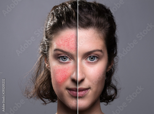 A beautiful and successful caucasian woman in her early thirties shows the before and after results of topical cream to reduce redness in the face, results of flawless complexion after treatment. photo