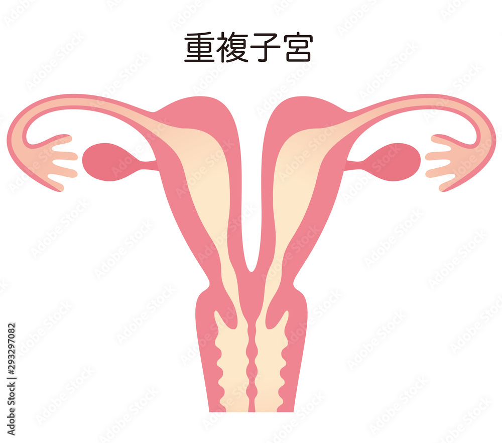 子宮奇形 重複子宮 Stock イラスト Adobe Stock