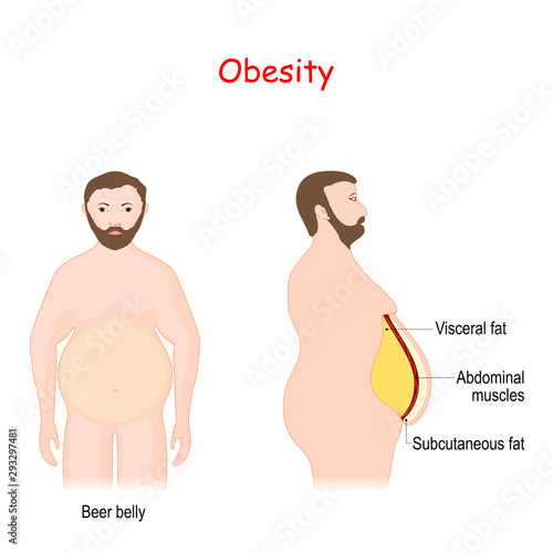 Abdominal obesity. Visceral and subcutaneous fat.