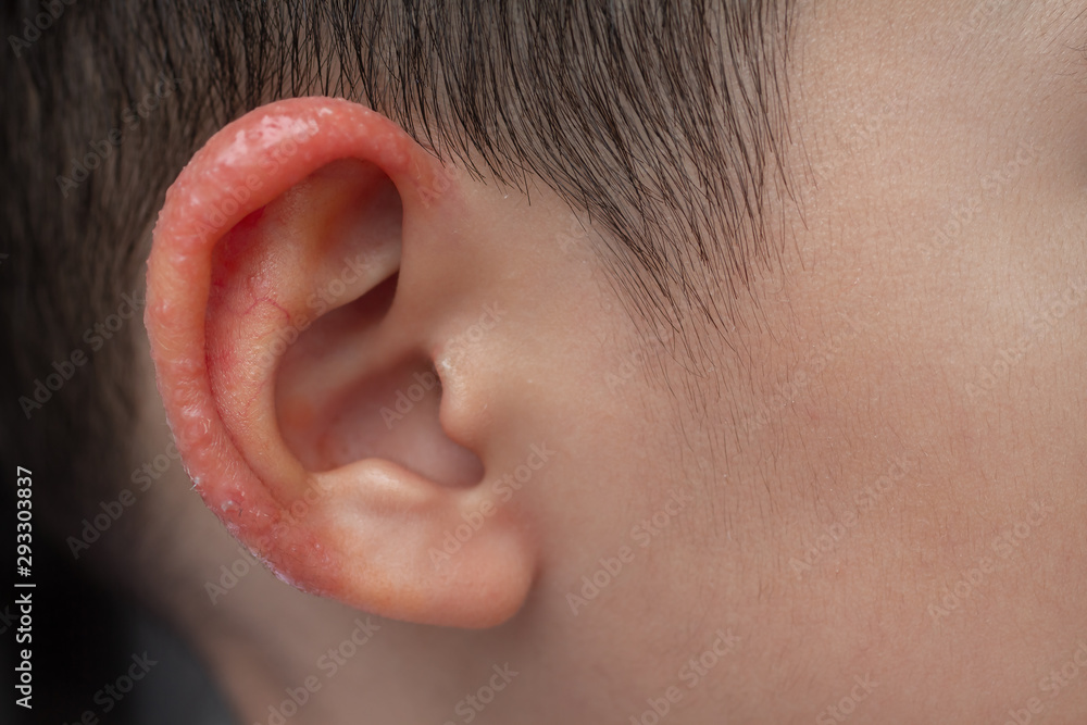 Close up child aurical (pinna) or external ear with inflamed skin from Atopic dermatitis. Selective focus at antihelix and scaphoid fossa of earlobe. Close up child aurical (pinna) or external ear with inflamed skin from Atopic dermatitis. Selective focus at antihelix and scaphoid fossa of earlobe.