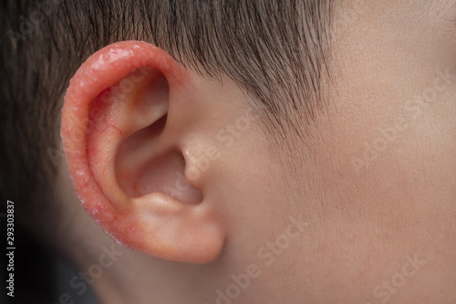 Close up child aurical (pinna) or external ear with inflamed skin from Atopic dermatitis. Selective focus at antihelix and scaphoid fossa of earlobe. photo