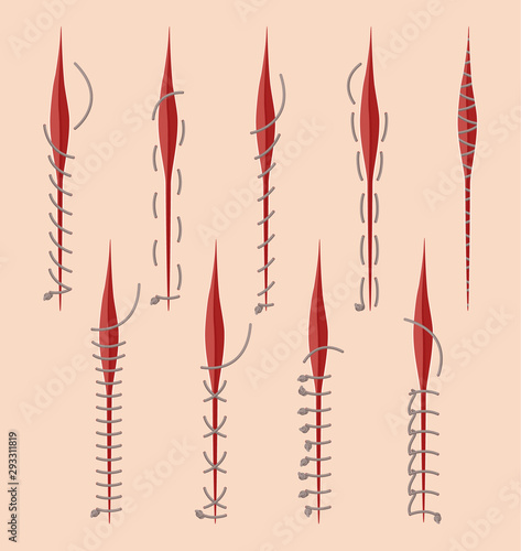 Series Of Different Medical Stitches Isolated On Pink Background