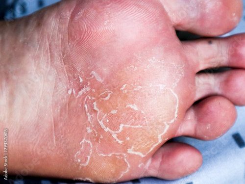  Close-up of under foot, dry skin texture