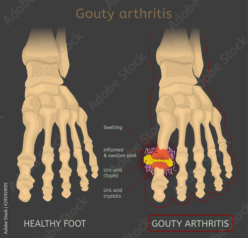 Gout arthritis image