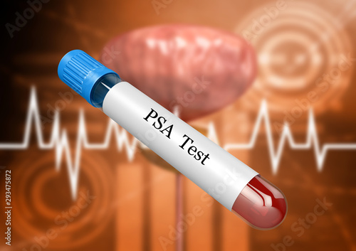 Blood sample in laboratory test tube for PSA examination for detection of prostate disorders and diseases photo
