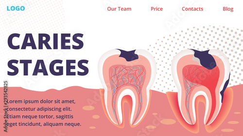 Caries Different Stages Treatment Vector Website