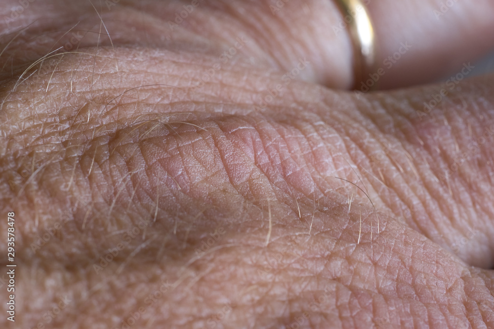 Foto Psoriasi Foto Psoriasi