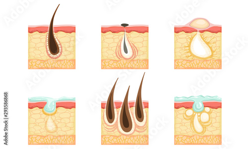 Set of skin images with hair roots, acne and sweat. Vector illustration.