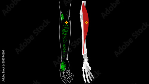 Brachioradialis muscle. Pain and trigger points in the hand.