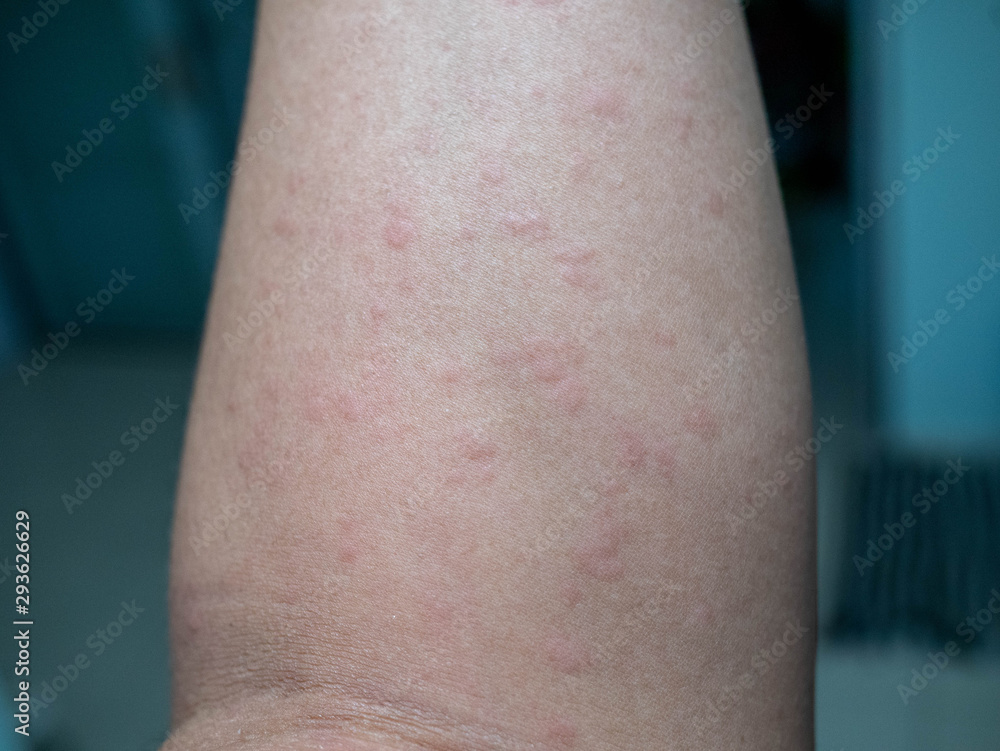 Fototapeta premium Rash on the skin