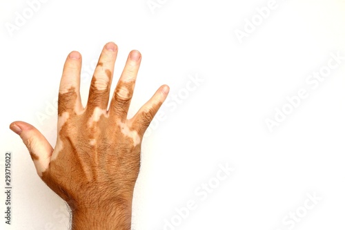 Vitiligo on hand on white isolated background with copy space