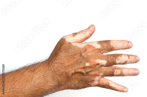 Vitiligo on spreading hand on white isolated background photo