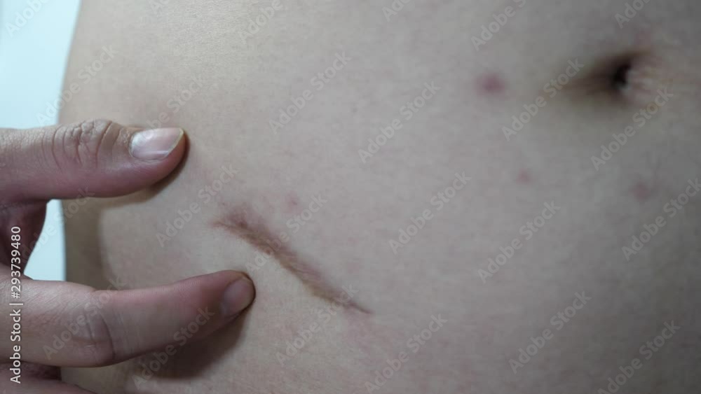 Scar of a man caused by an appendicitis surgery. Scar of a man caused by an appendicitis surgery.
