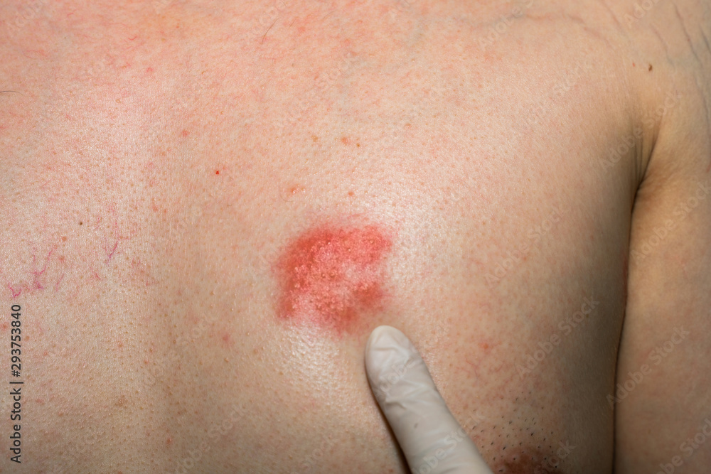 Fototapeta premium Doctor wear a glove and pointing to Herpes zoster at chest. Detail of skin infected.