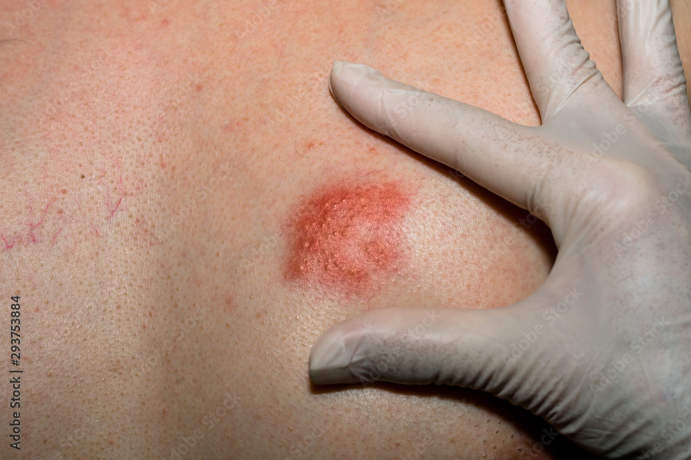 Fototapeta premium Doctor wear a glove and pointing to Herpes zoster at chest. Detail of skin infected.