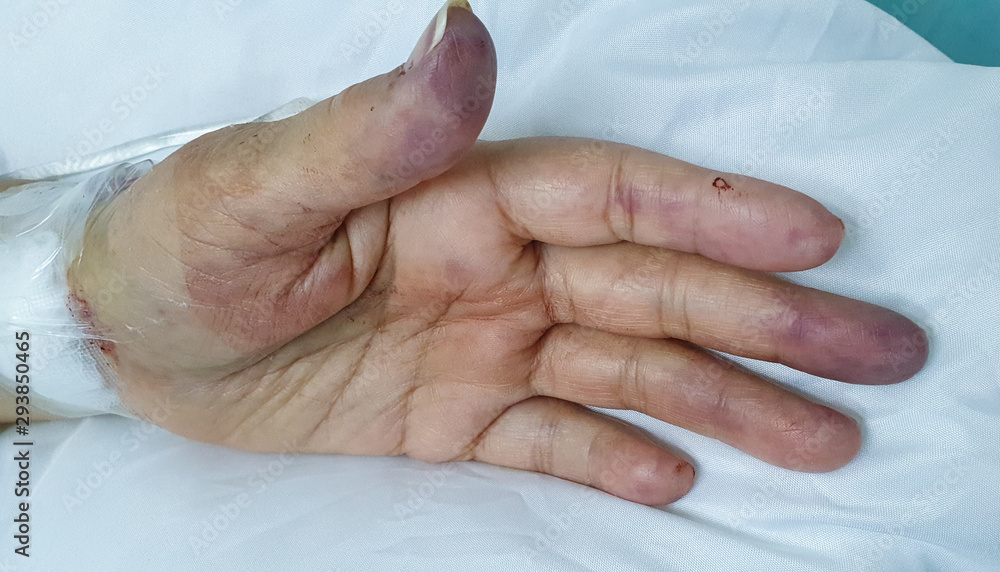 Left hand radial artery partial obstruction