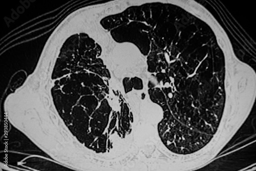 Murais de parede CAT -Scan: emphysema  and lung tumor