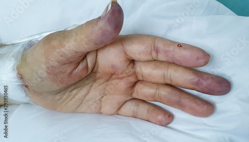Obraz na płótnie Left hand radial artery partial obstruction w salonie
